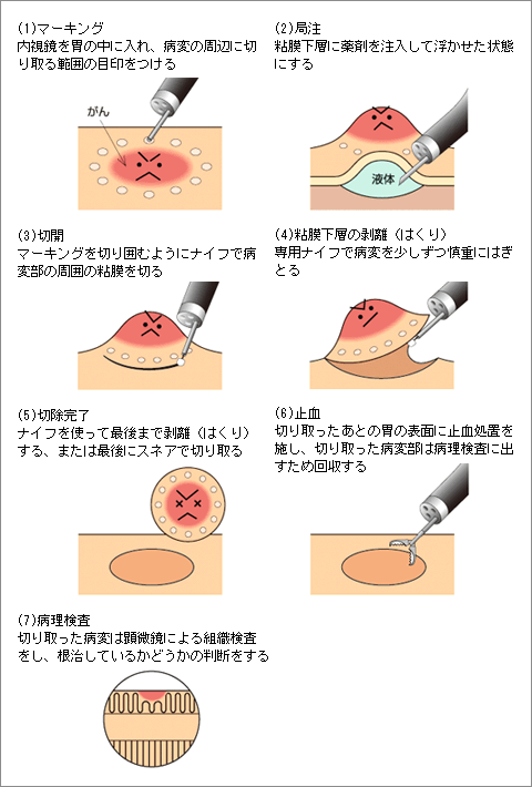 内視鏡的粘膜下層はく離術(ESD)